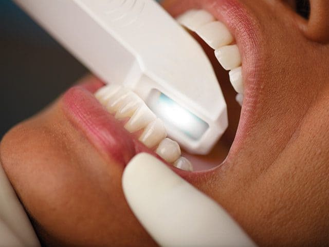 Intraoralscan bei topDentis Cologne